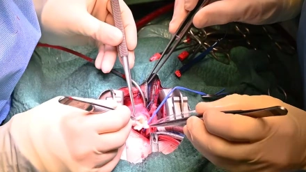 Mariami, primera bebé en España con un trasplante parcial de corazón