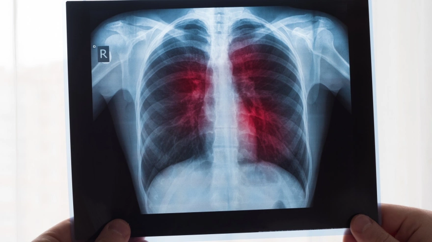 Radiografía de pulmones
