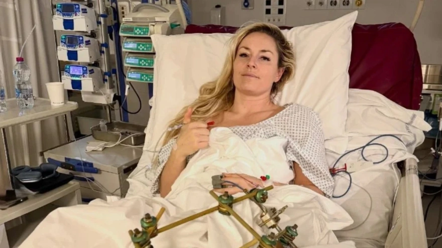 Lindsey Vonn sufrió una fractura de tibia que se unió a la de cruzado que ya tenía.