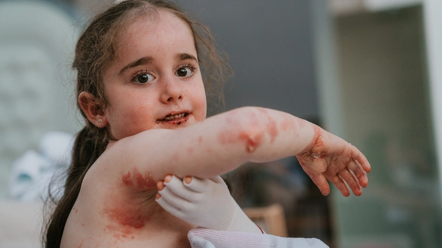 (Foto de ARCHIVO)Piel de mariposa.REMITIDA / HANDOUT por MARTÍN CORRADINIFotografía remitida a medios de comunicación exclusivamente para ilustrar la noticia a la que hace referencia la imagen, y citando la procedencia de la imagen en la firma16/8/2022