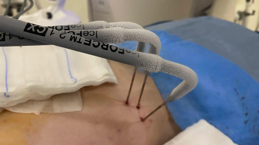 Agujas de crioablación con el hielo necesario para la intervención de tumores