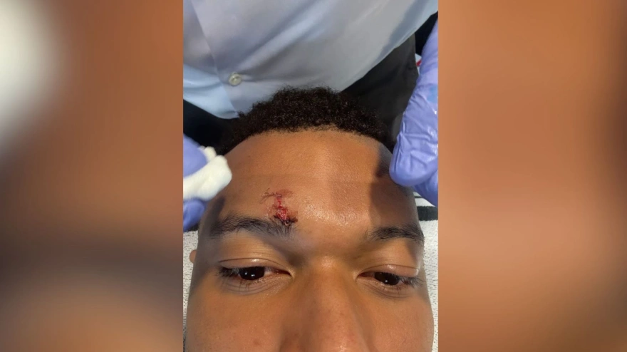 Mbappé enseña su ceja tras la acción del penalti que pidió ante el Girona