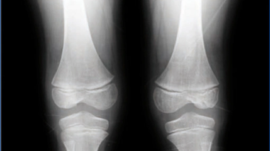 Qué es el síndrome uña-rótula, la enfermedad genética sin cura que afecta a riñones, ojos y huesos: "600 casos en España"